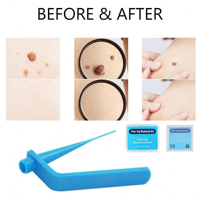 Home Micro Skin Tag Remover Set Medium Body Mole Odstraňovač Bradavic Pásek Na Odstranění Kožních Štítků